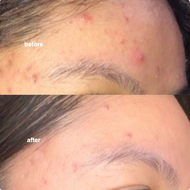 Anti-Acne Serum