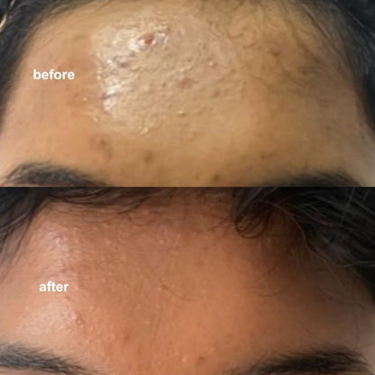 Anti-Acne Serum